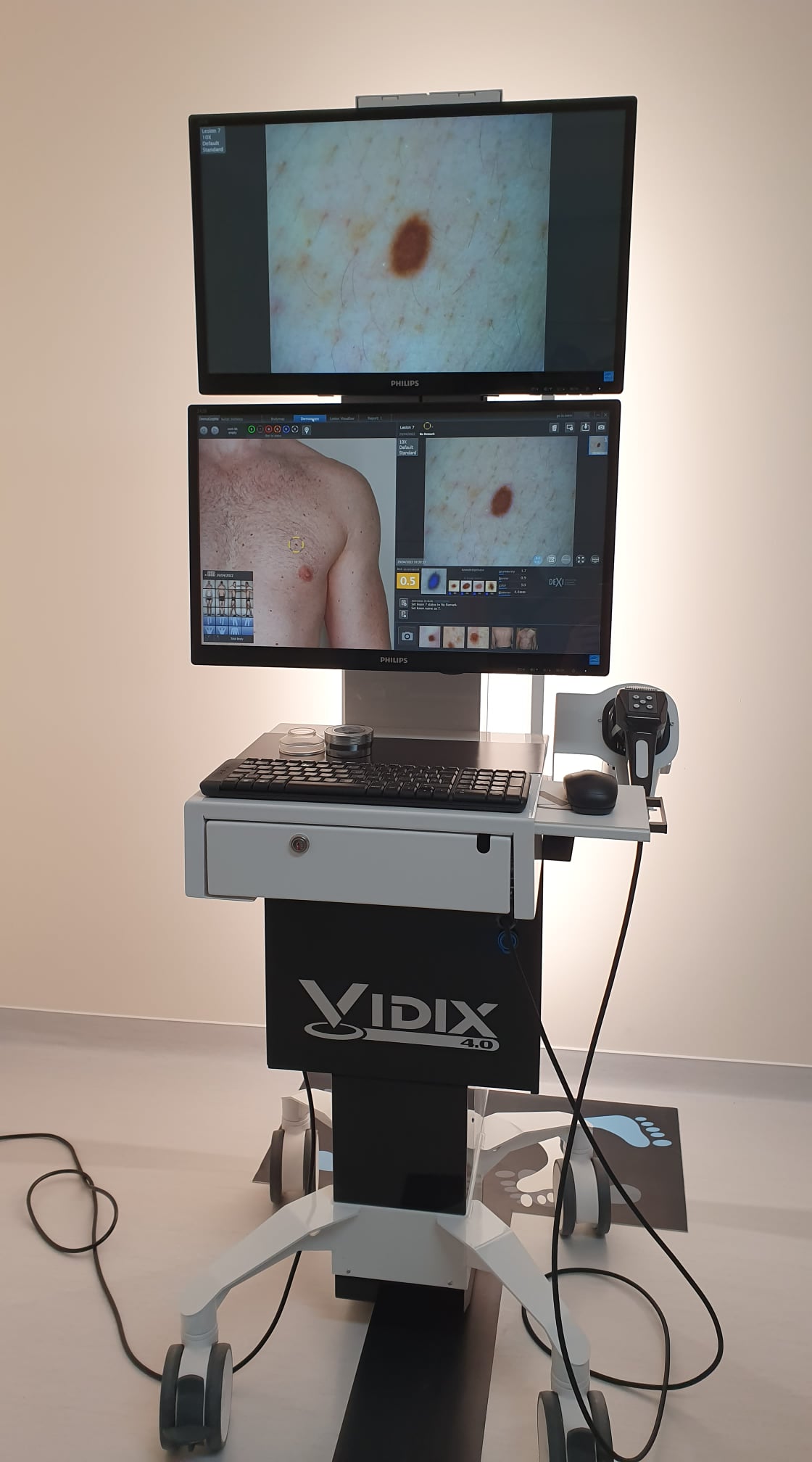 Videodermatoscopia - stetoscopul și microscopul dermatologului - Esderm Cabinet dermatologie estetica Suceava
